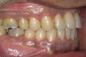 Melanosis gingival tratamiento Clínica dental Bilbao